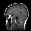 MRI scan of head